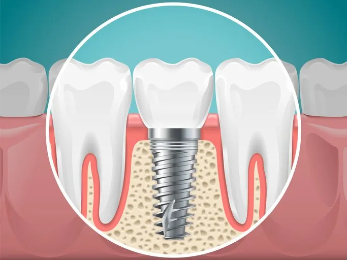 Implants